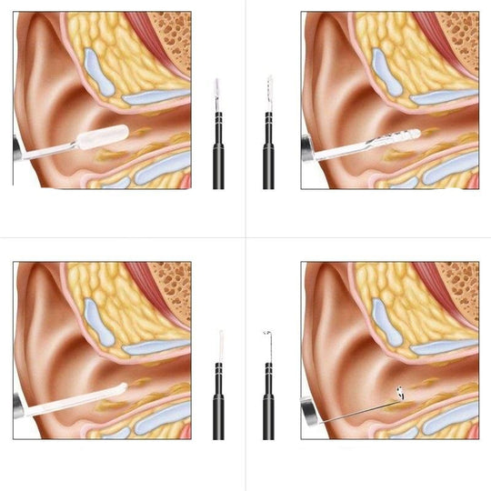 Live Ear Medicinale oor endoscoop. Belleza
